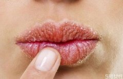 什么是唇膜炎 唇膜炎的症状有什么