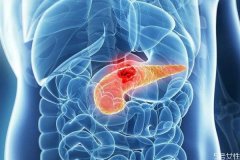 胰腺癌的症状有什么呢 胰腺癌造成的原因有什么呢
