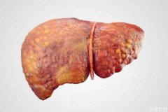什么是肝癌呢 肝癌有什么症状呢